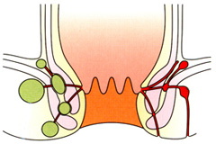 肛瘘怎么回事呢