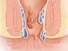 得了内痔用什么方法治疗好呢