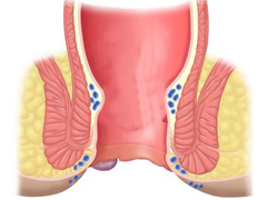 外痔是什么样的