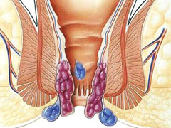 痔疮是什么样的呢